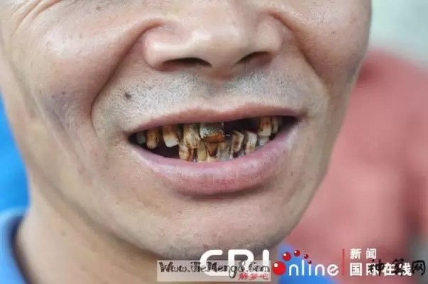 女人梦见牙齿大把脱落,解梦牙齿掉了吐一大把插图
