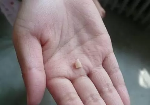 上牙代表父母下牙代表儿女,上牙掉了有啥预兆插图