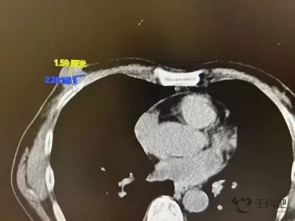75岁上海老爷叔确诊乳腺癌！哪类男性容易得这病？插图1
