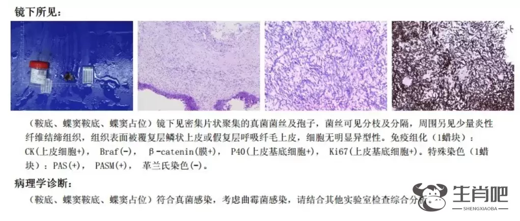 阿姨眼睛疼了大半年竟是脑袋“发霉”了……插图1