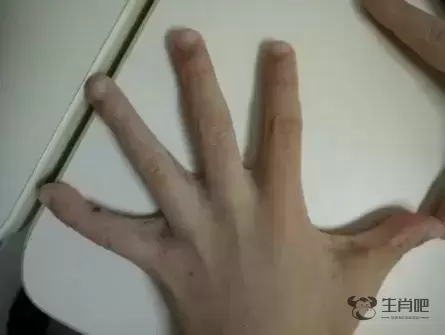 一人得病，可能全家“痒到怀疑人生”插图